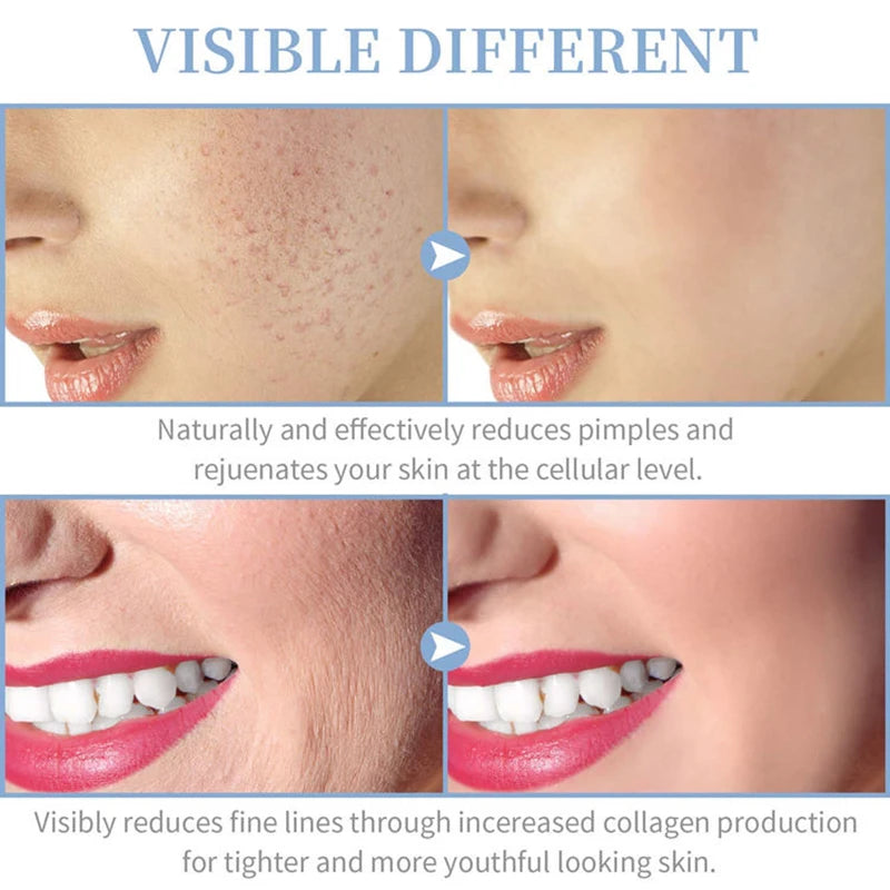 High Frequency Skin Therapy Wand